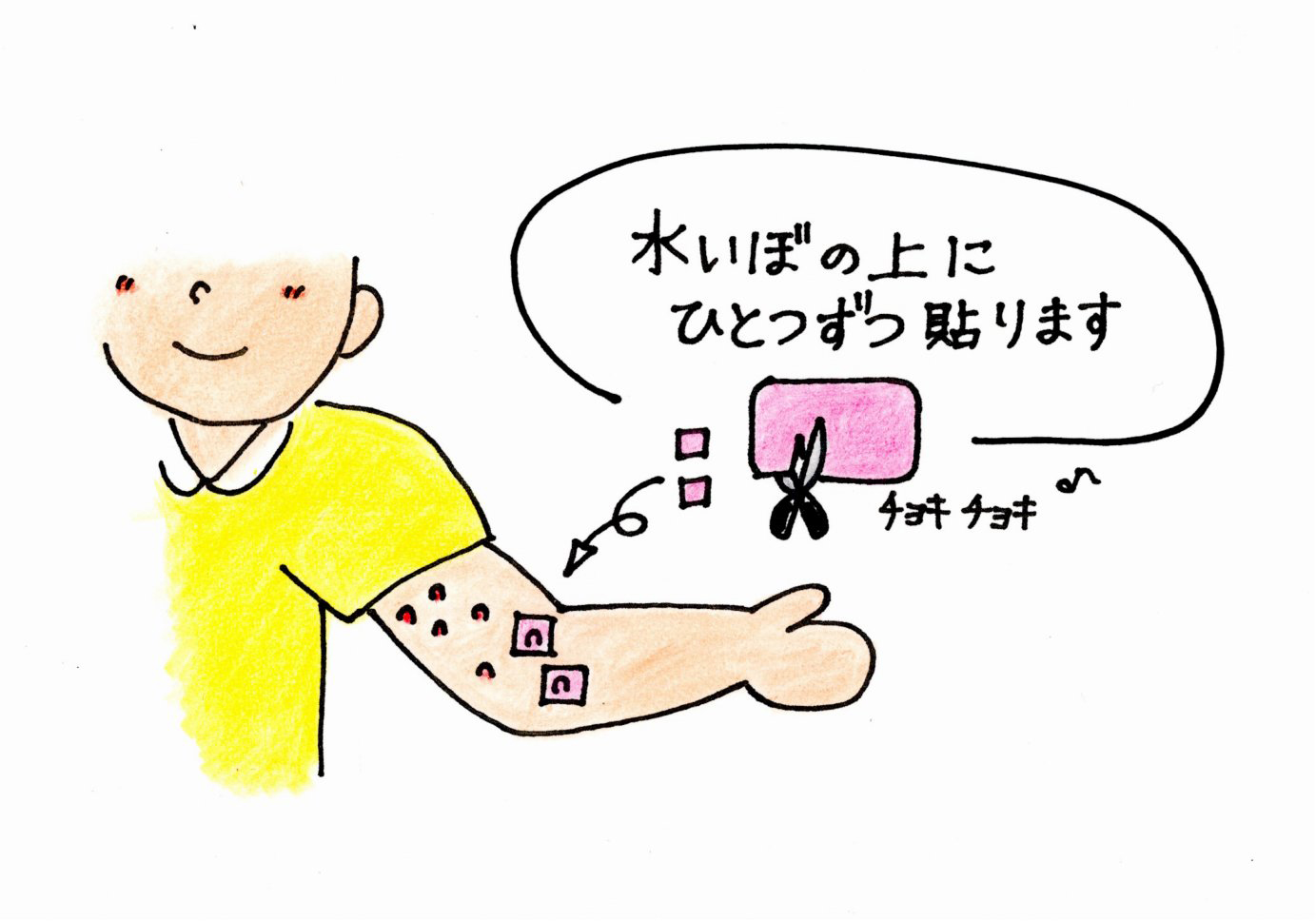 水いぼ(伝染性軟属腫)の治療